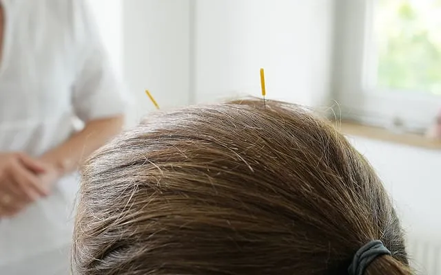 Schädelakupunktur mit feinen Nadeln am Kopf